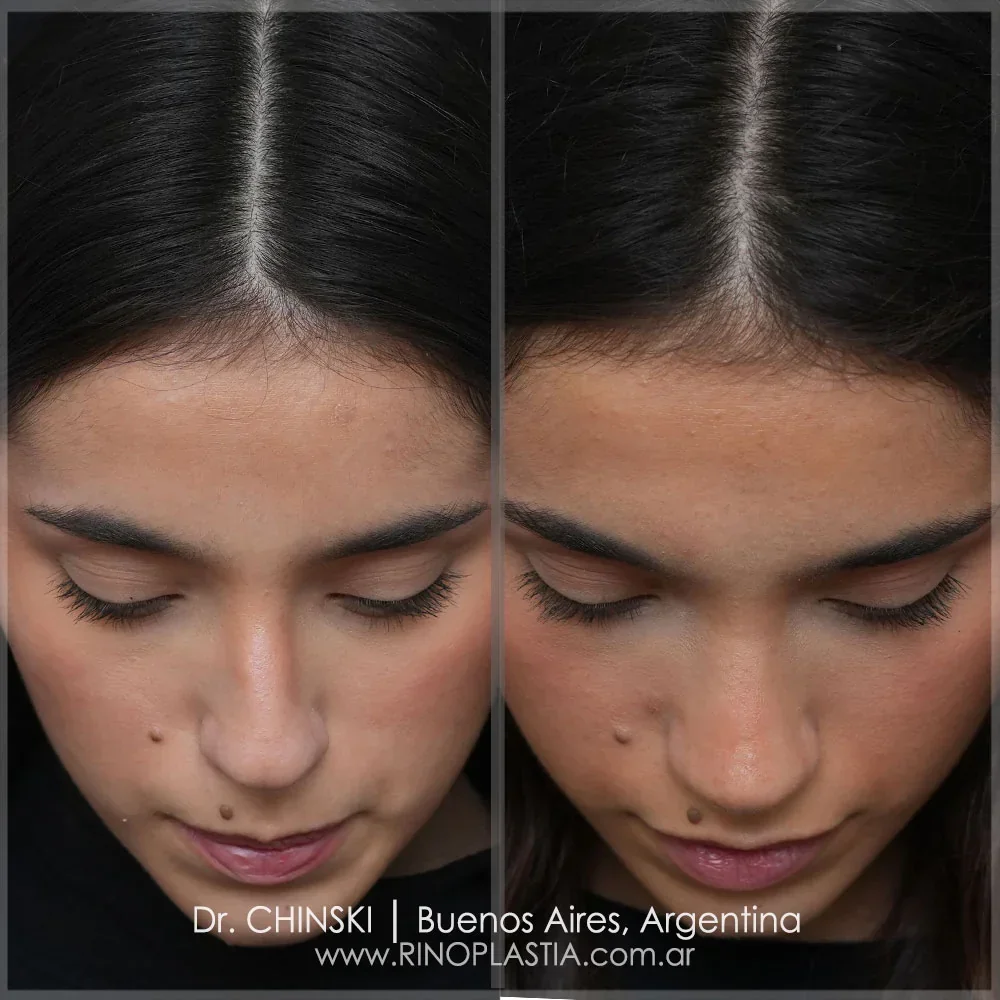 Rinoplastia com fins estéticos e funcionais