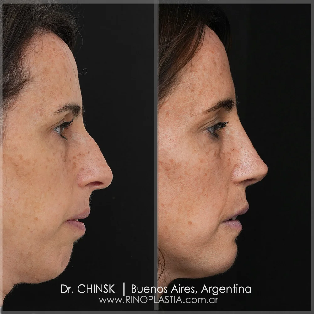 Rinoplastia combinada com mentoplastia