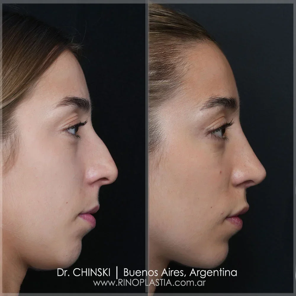 Resultado de rinoplastia primária