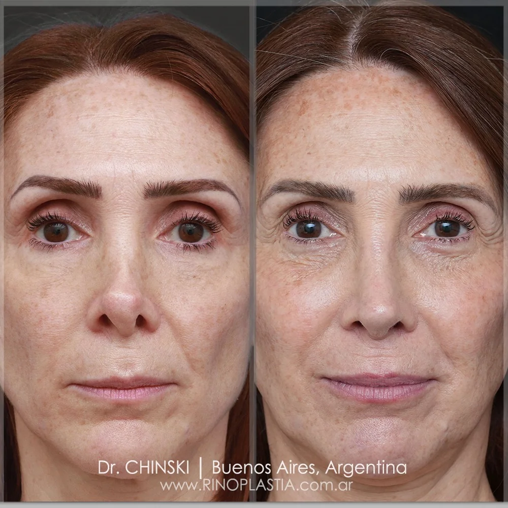 Resultado de rinoplastia secundária
