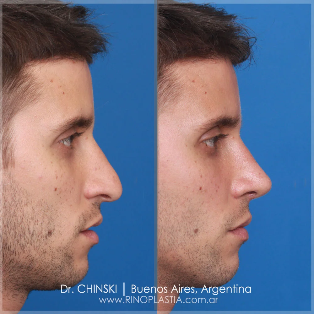 Antes e depois de rinoplastia – caso 100