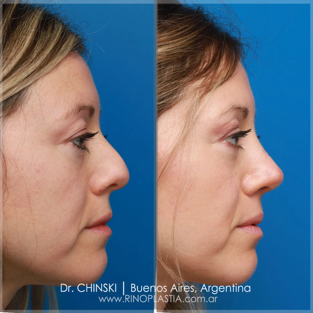 Antes e depois de rinoplastia – caso 101