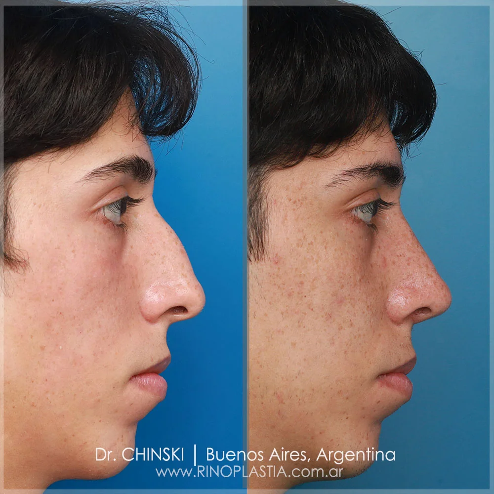 Antes e depois de rinoplastia – caso 102