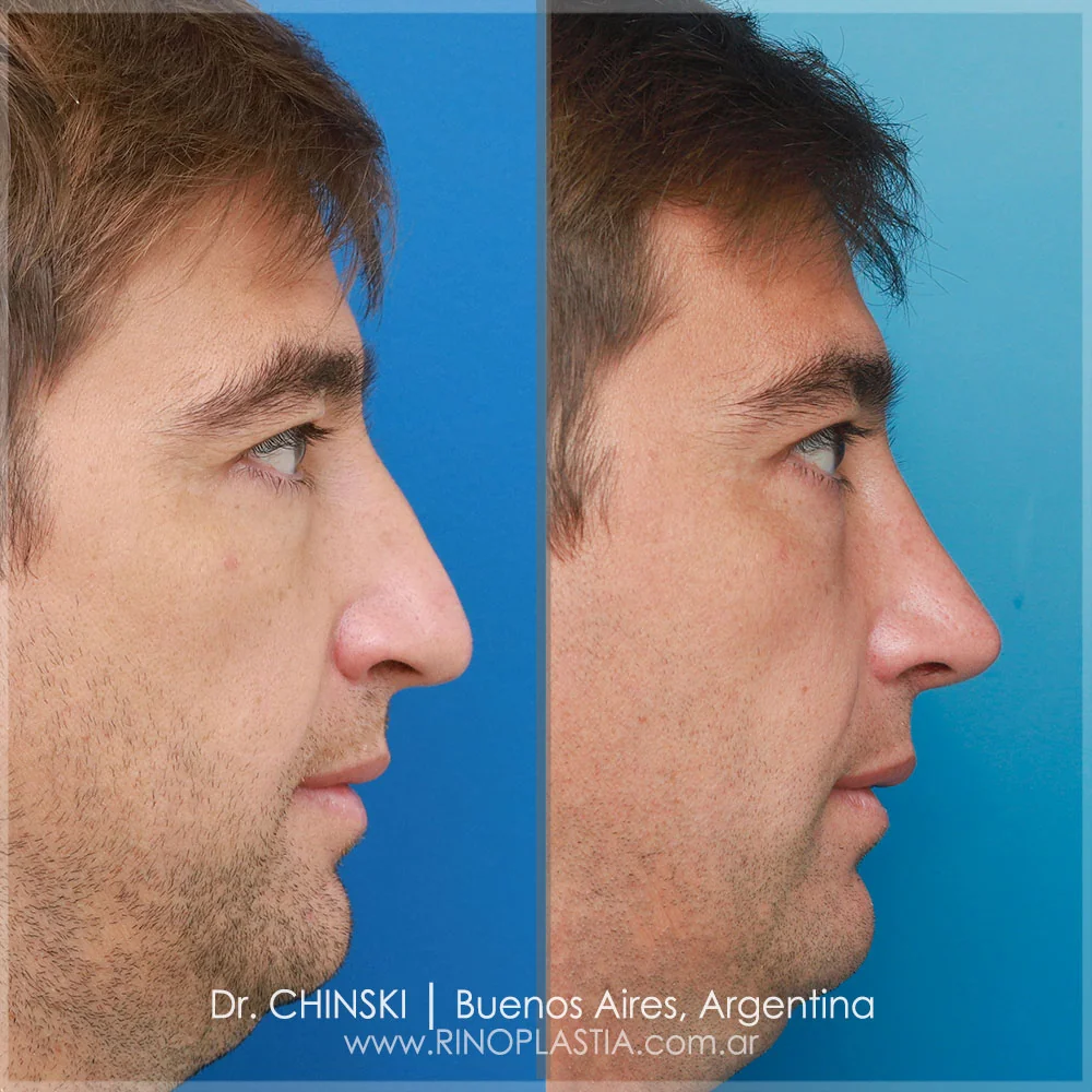 Antes e depois de rinoplastia – caso 103