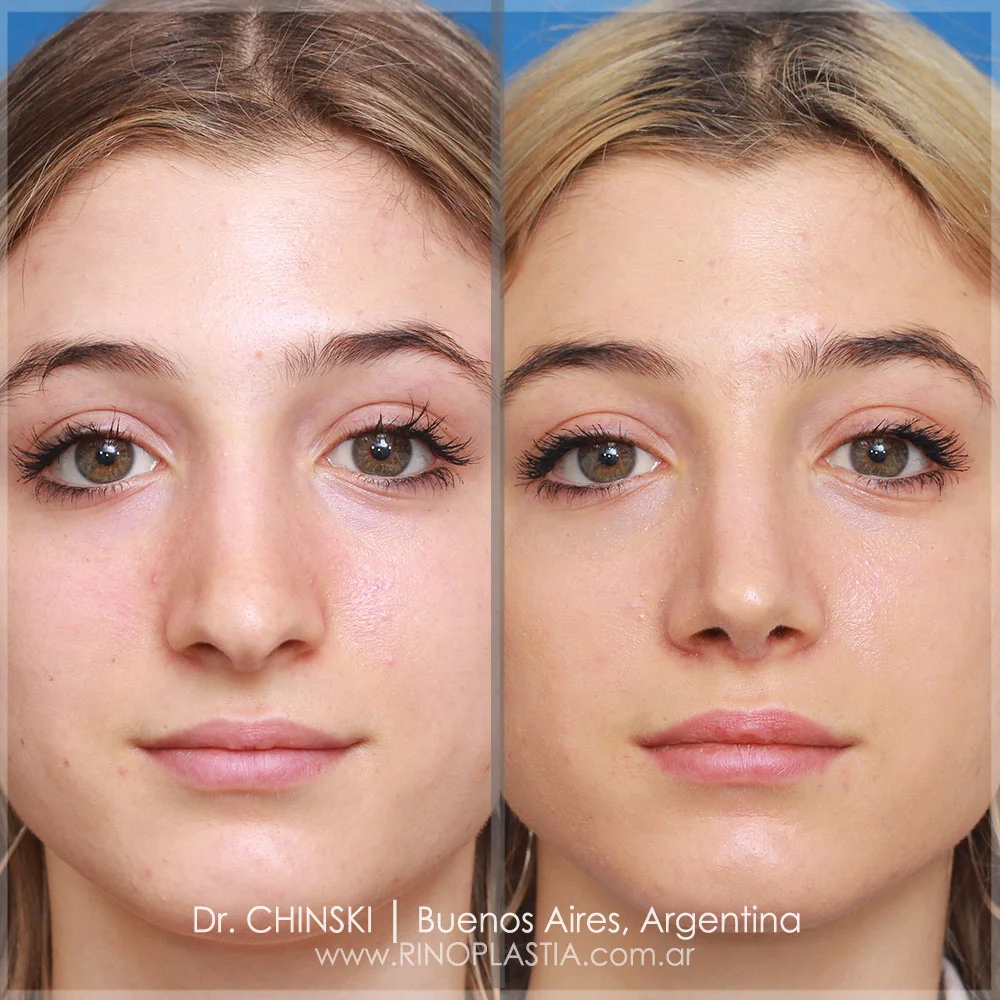 Antes e depois de rinoplastia – caso 104