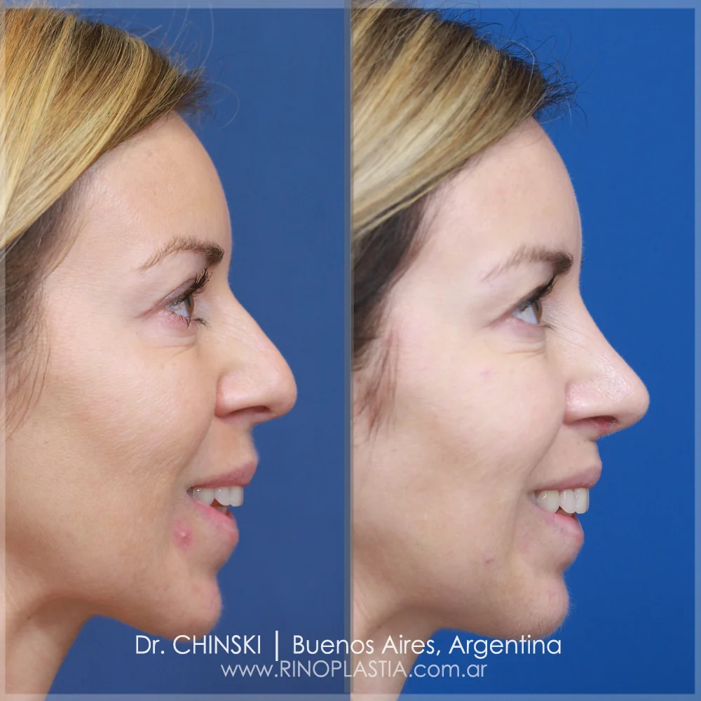 Antes e depois de rinoplastia – caso 105