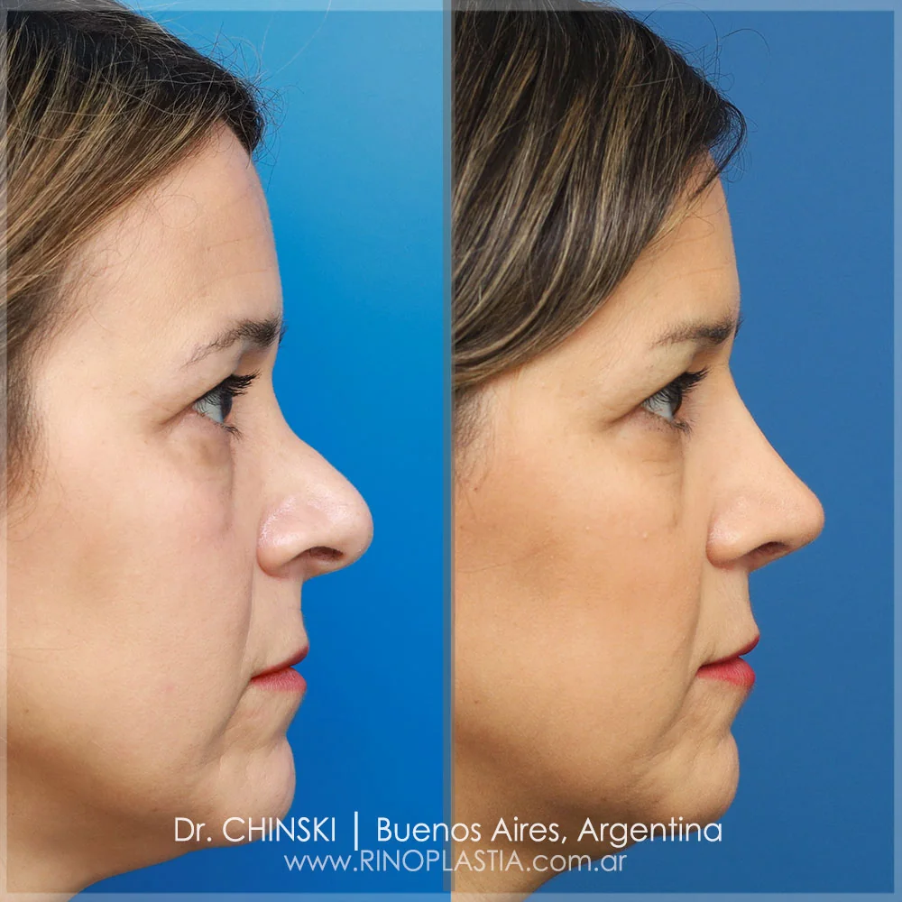 Rhinoplasty before and after – case 106