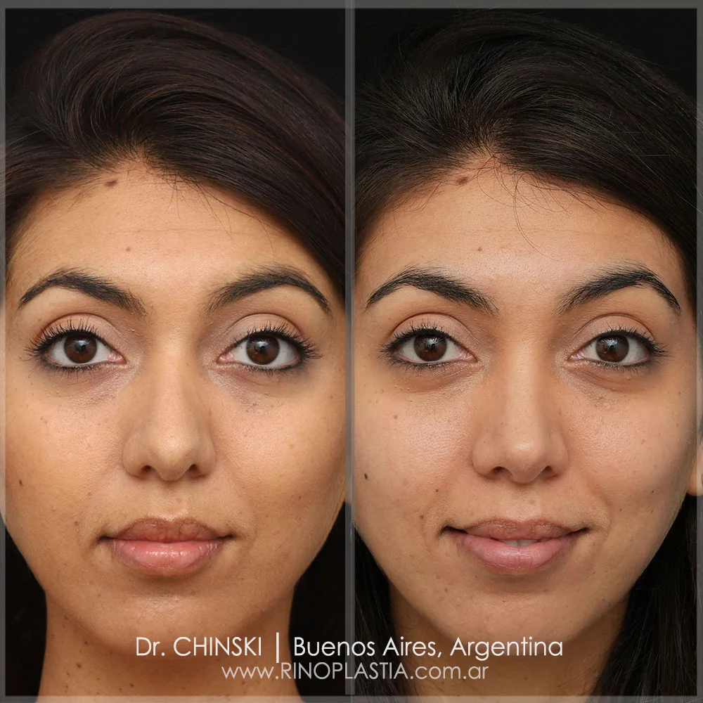 Antes e depois de rinoplastia – caso 107