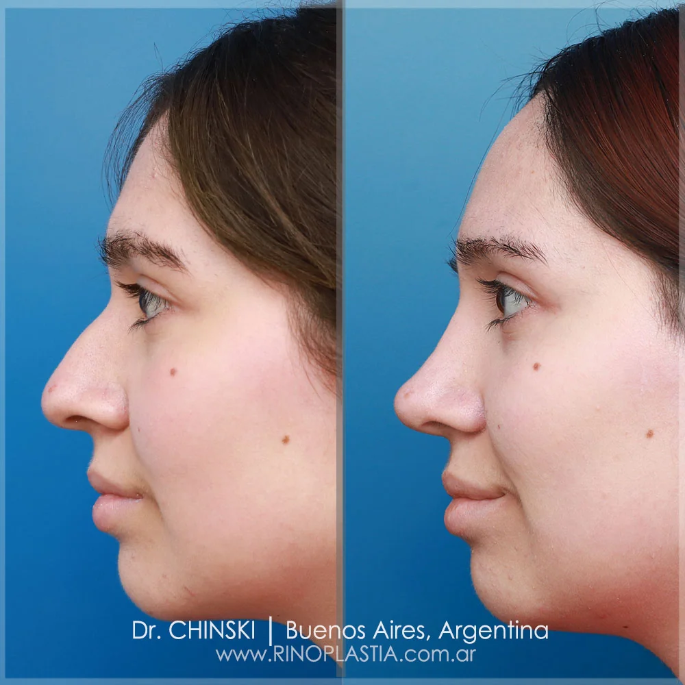 Antes e depois de rinoplastia – caso 108