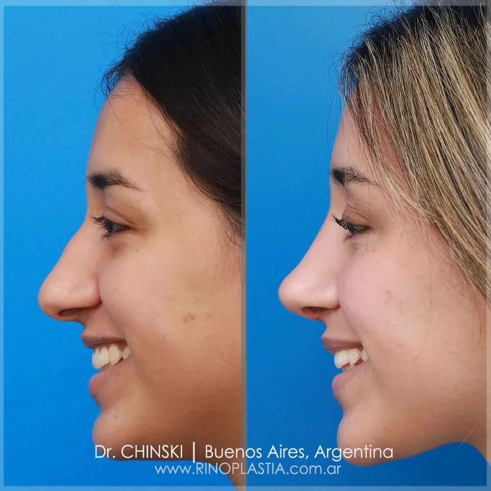 Antes e depois de rinoplastia – caso 109