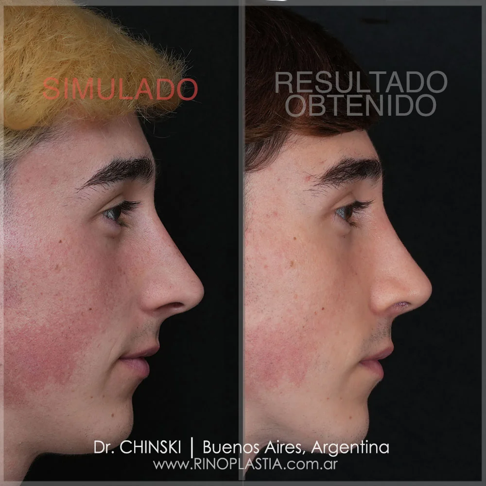 Rhinoplasty before and after – case 11