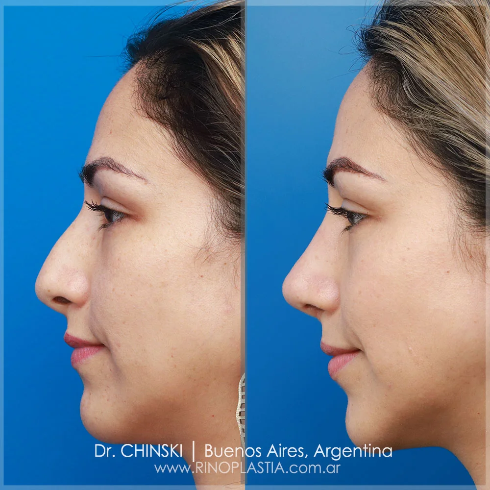 Rhinoplasty before and after – case 110