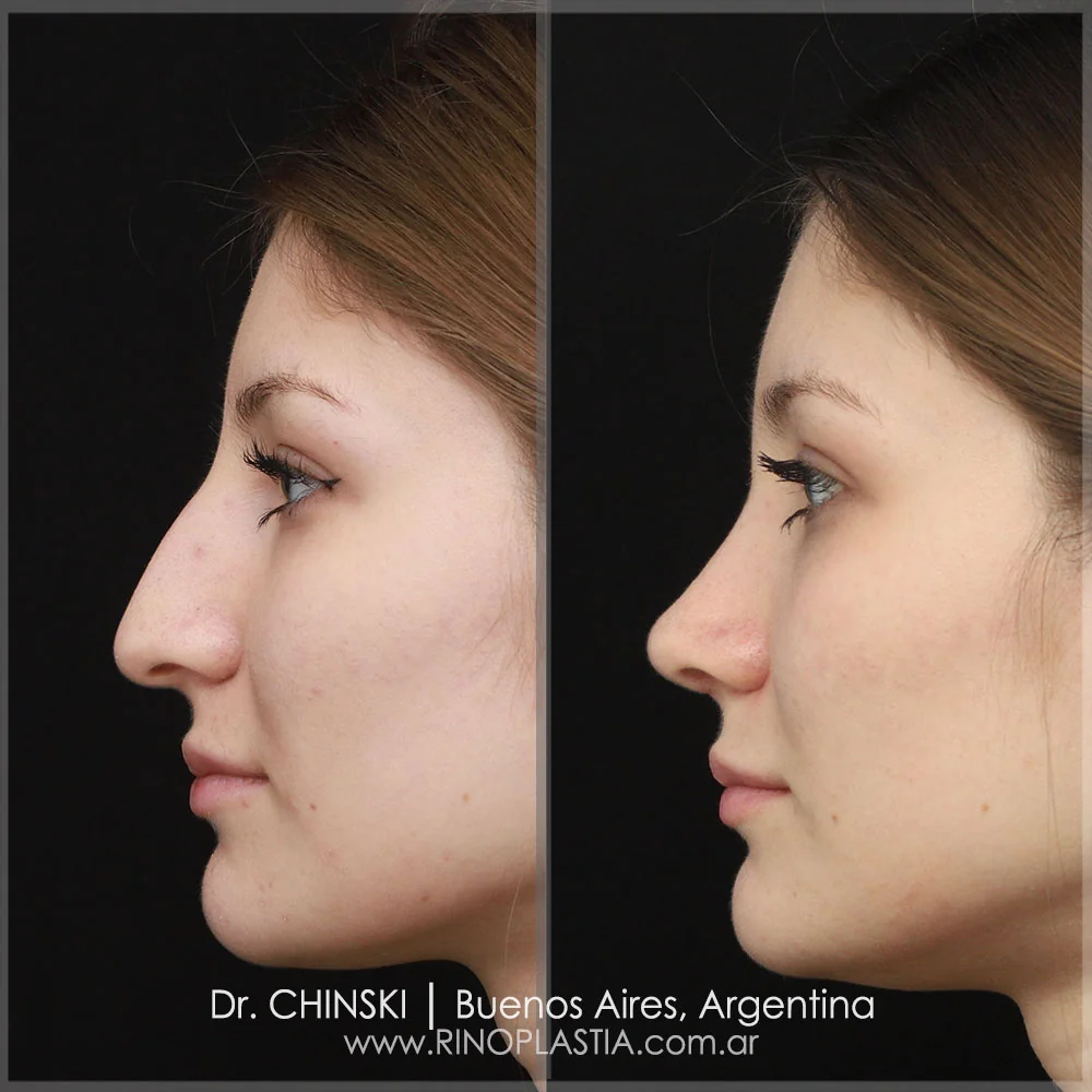 Antes e depois de rinoplastia – caso 111