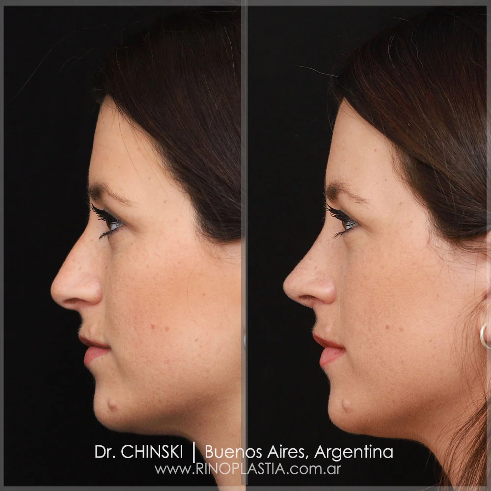 Antes e depois de rinoplastia – caso 112