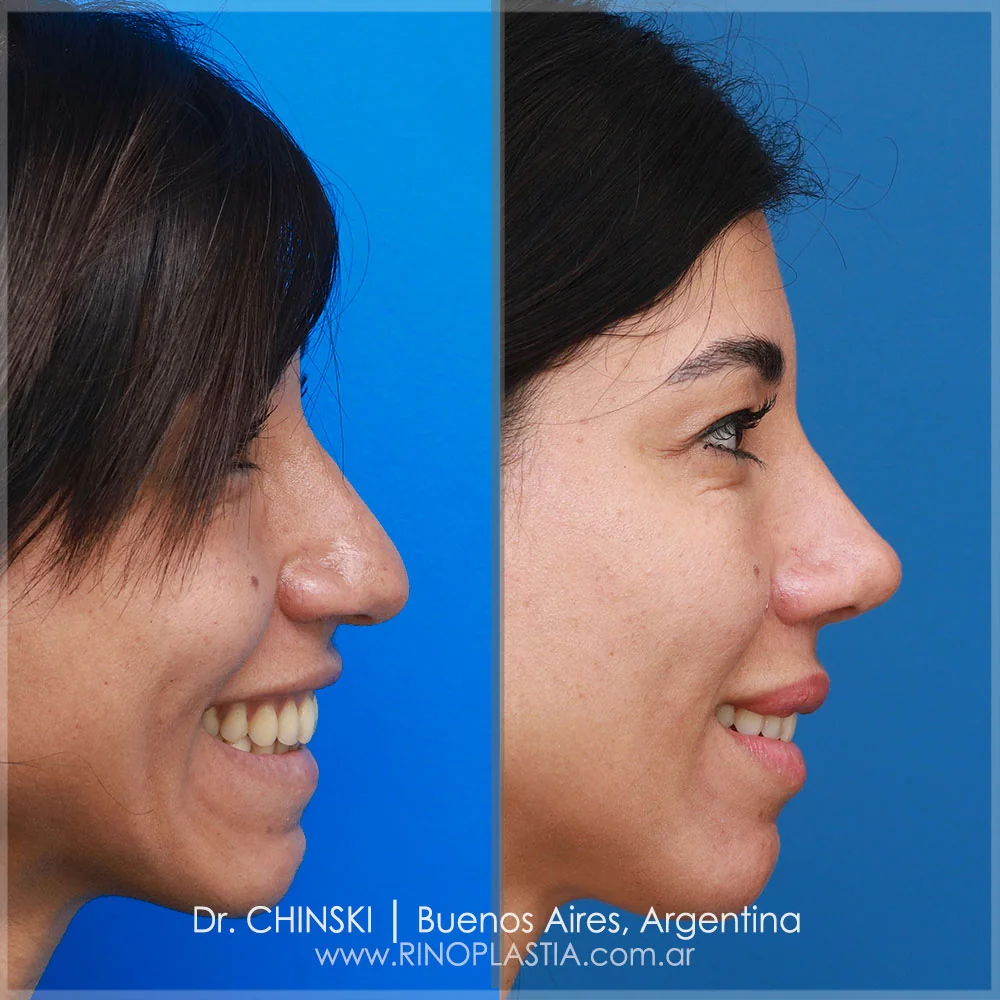 Antes e depois de rinoplastia – caso 113