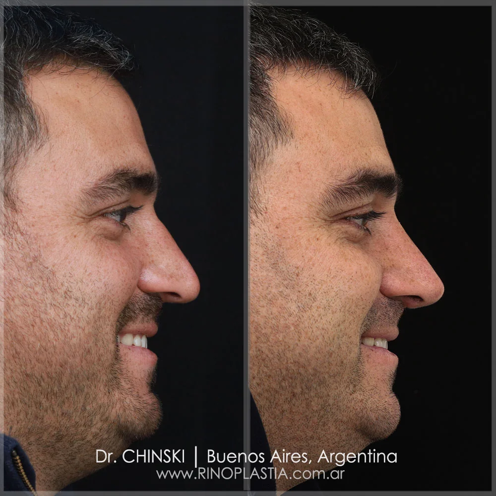 Antes y después de rinoplastia – caso 114