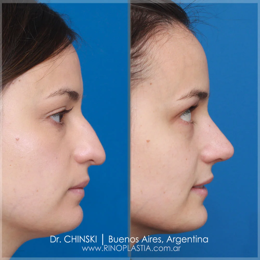 Antes e depois de rinoplastia – caso 115