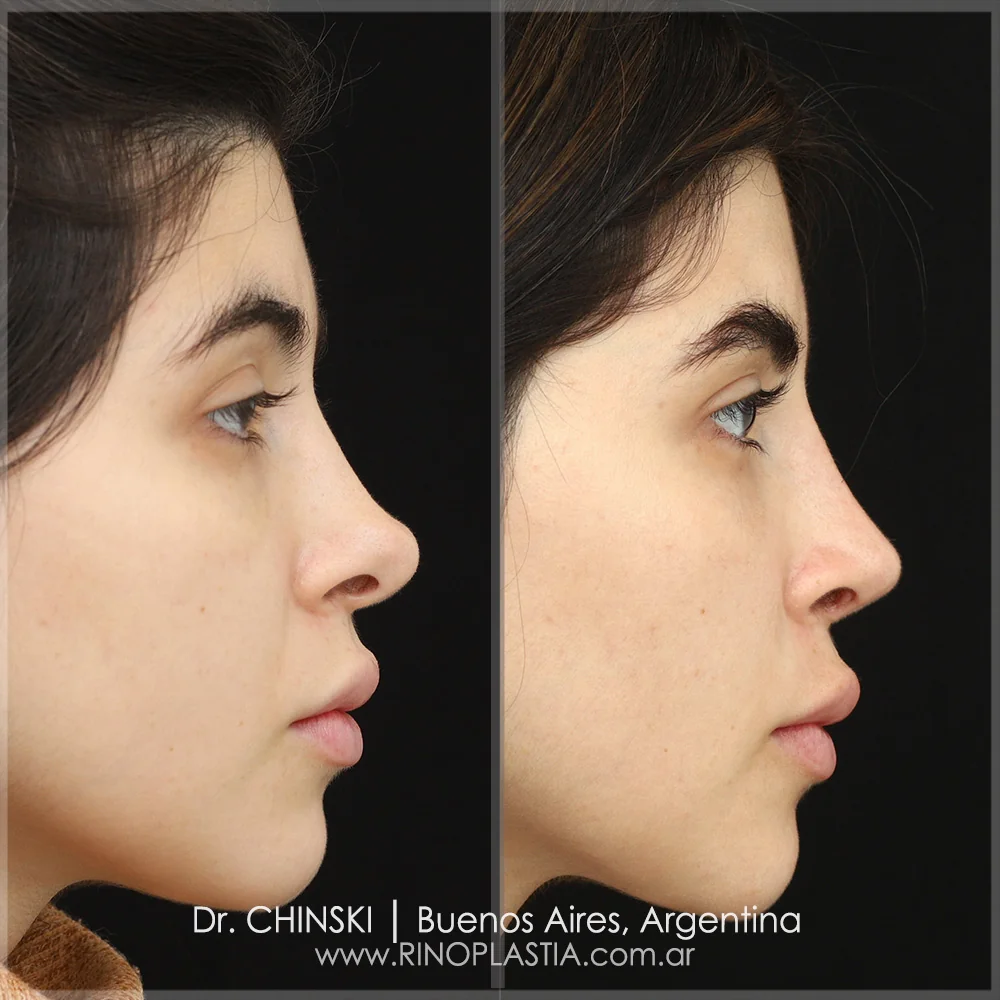 Rhinoplasty before and after – case 116