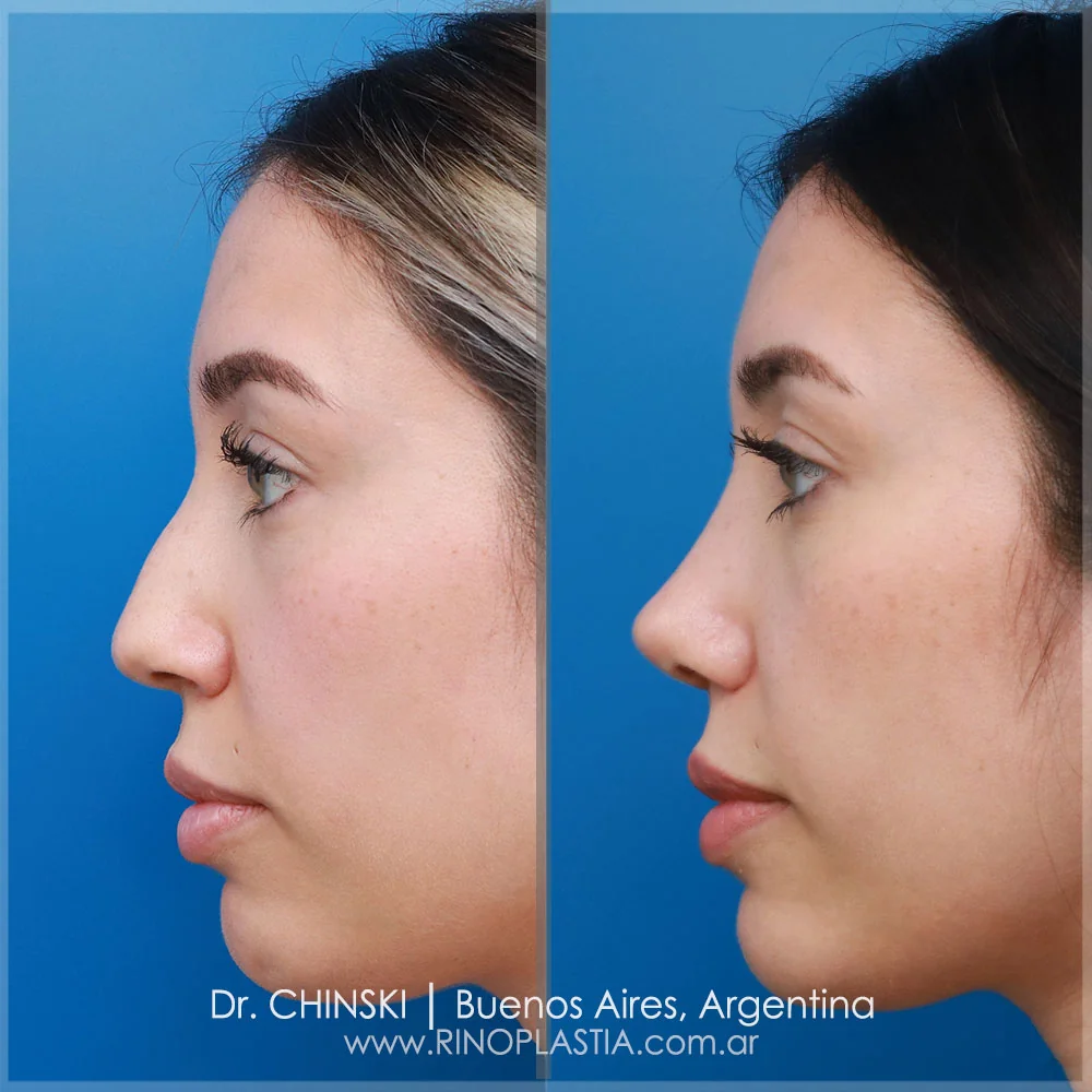 Antes e depois de rinoplastia – caso 117