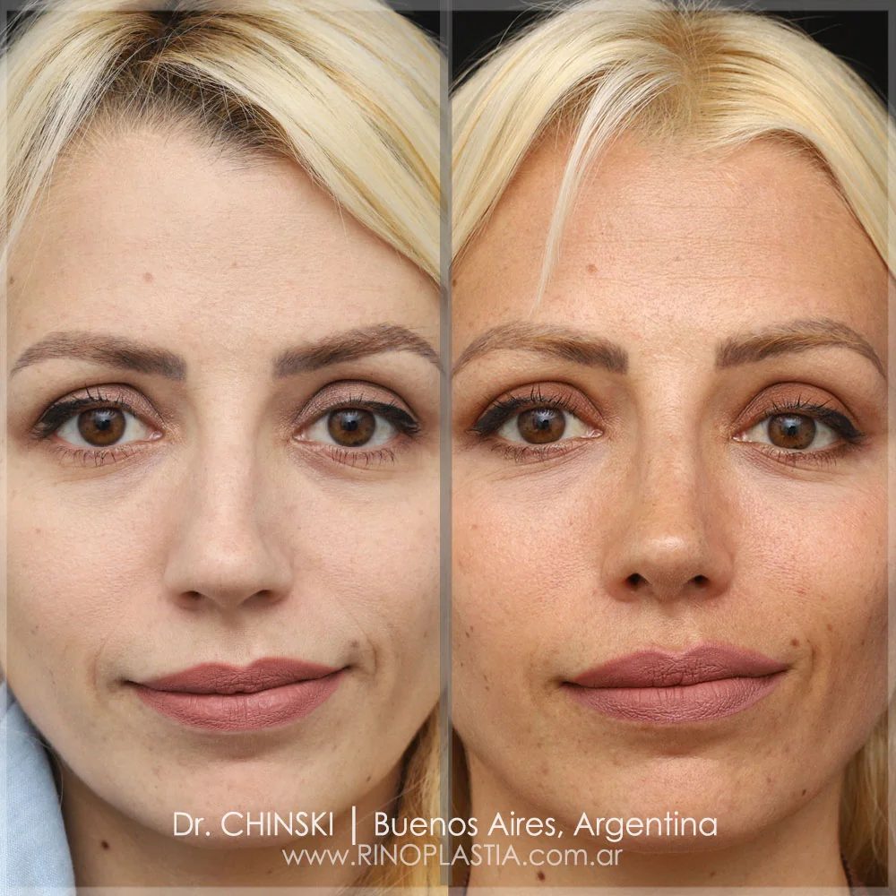 Antes e depois de rinoplastia – caso 118