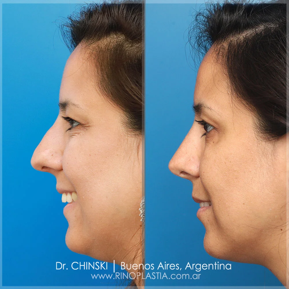 Antes y después de rinoplastia – caso 119