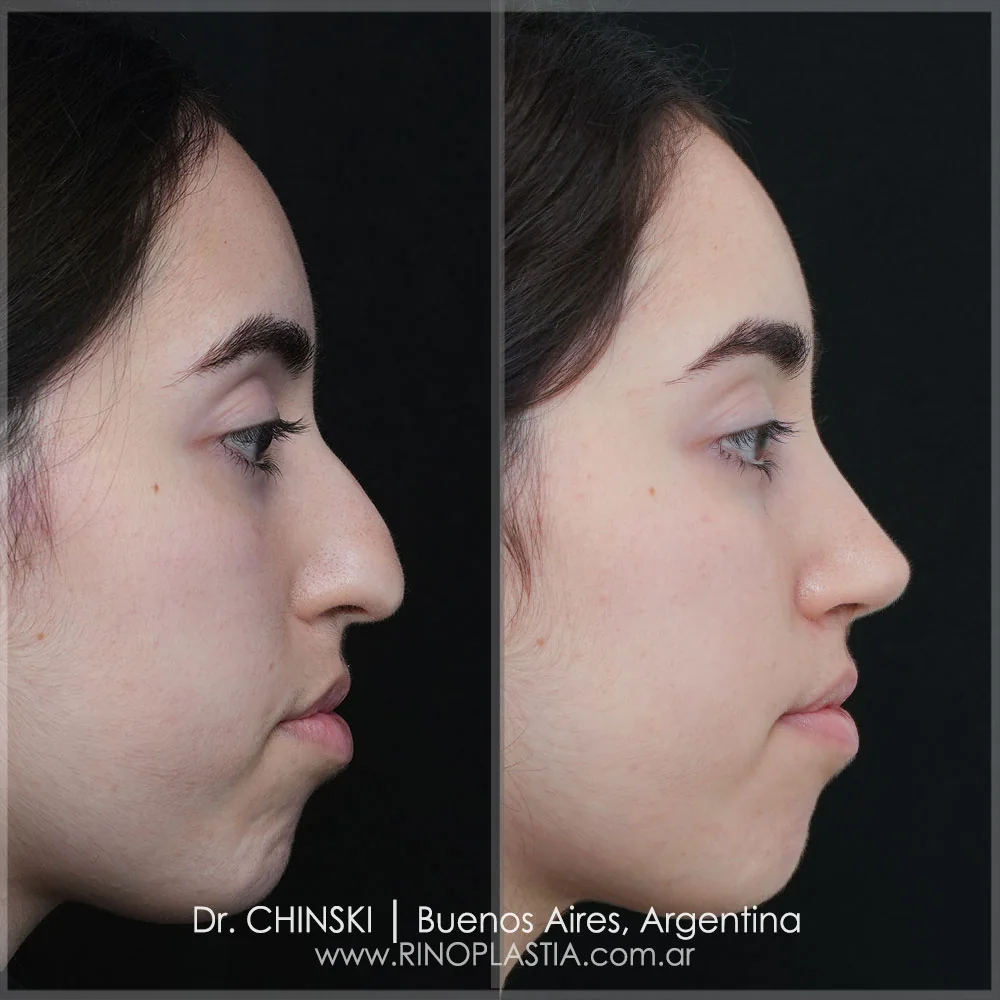 Rhinoplasty before and after – case 12
