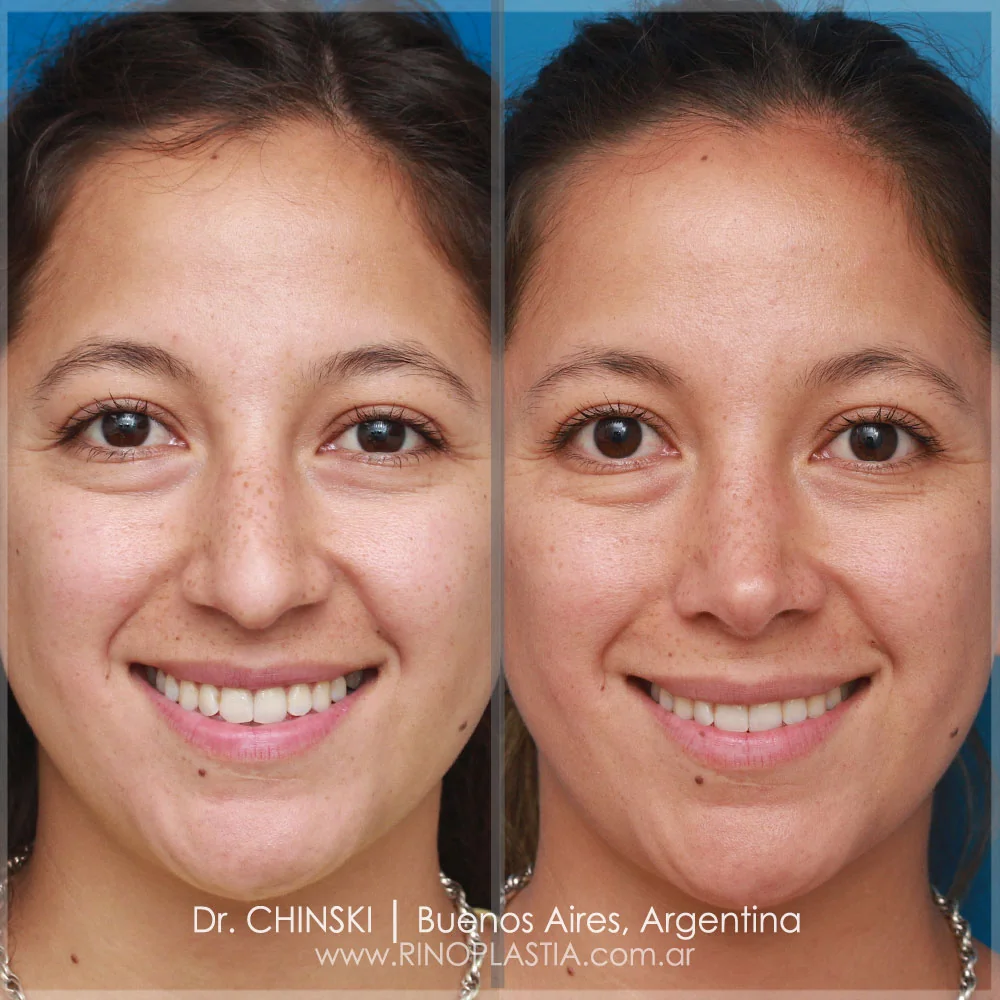 Antes e depois de rinoplastia – caso 120