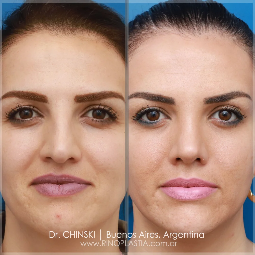 Antes e depois de rinoplastia – caso 121