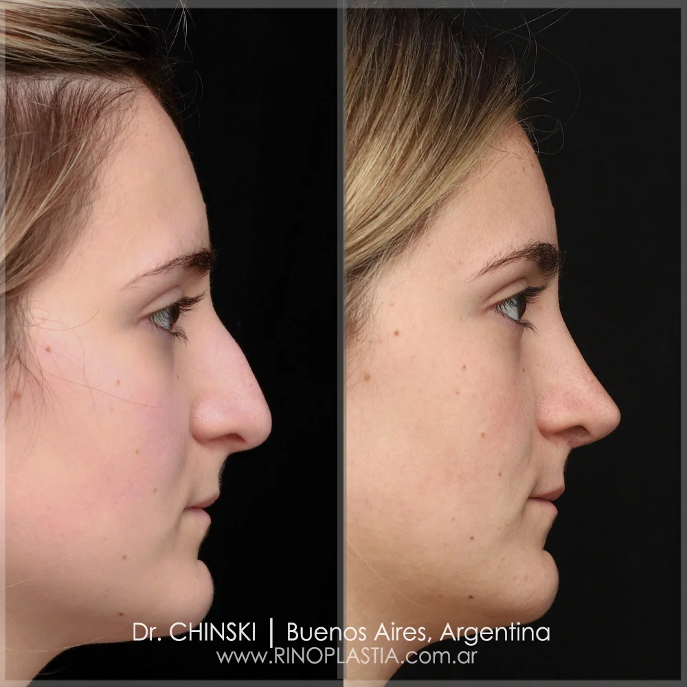 Antes e depois de rinoplastia – caso 122
