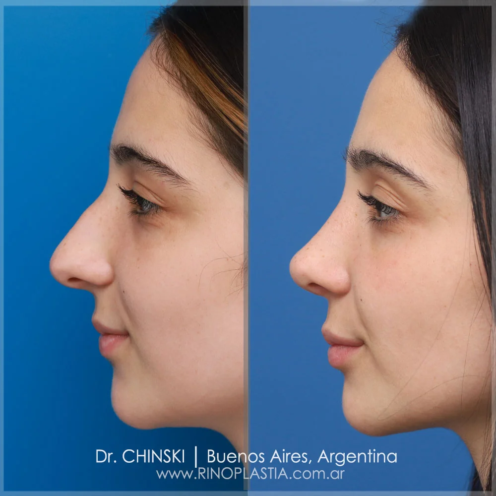 Rhinoplasty before and after – case 123