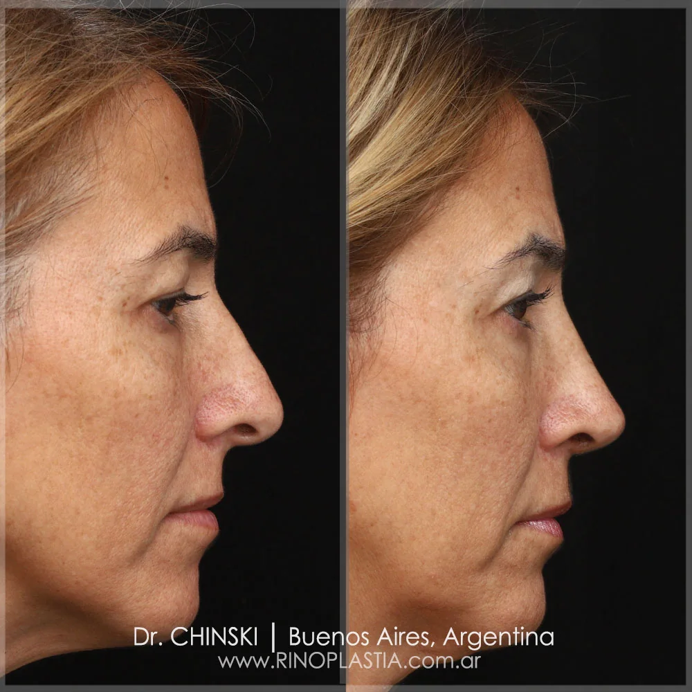 Rhinoplasty before and after – case 124