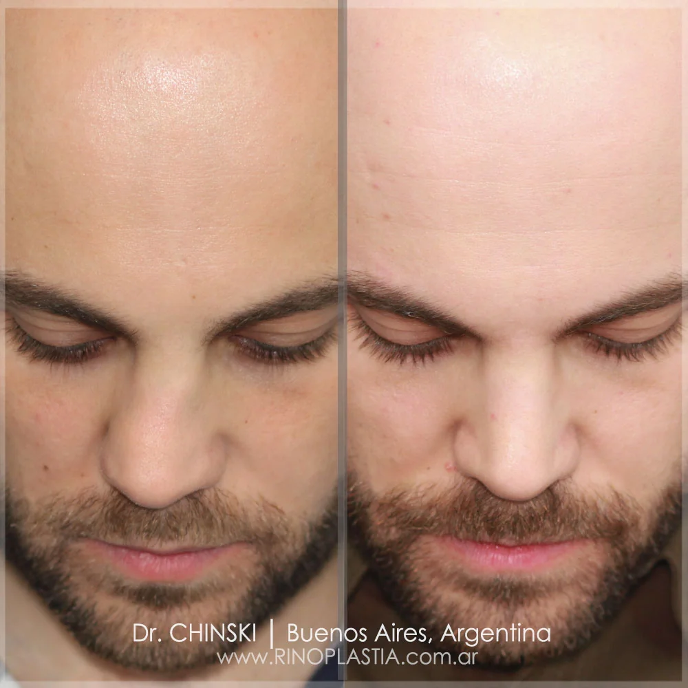 Antes e depois de rinoplastia – caso 125