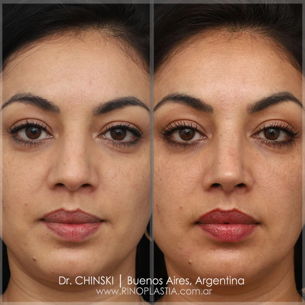 Antes e depois de rinoplastia – caso 126
