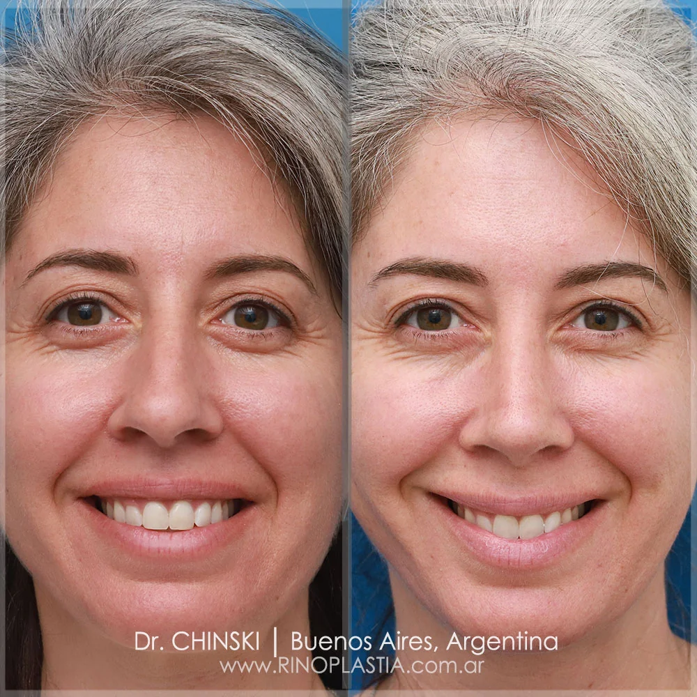 Antes e depois de rinoplastia – caso 127