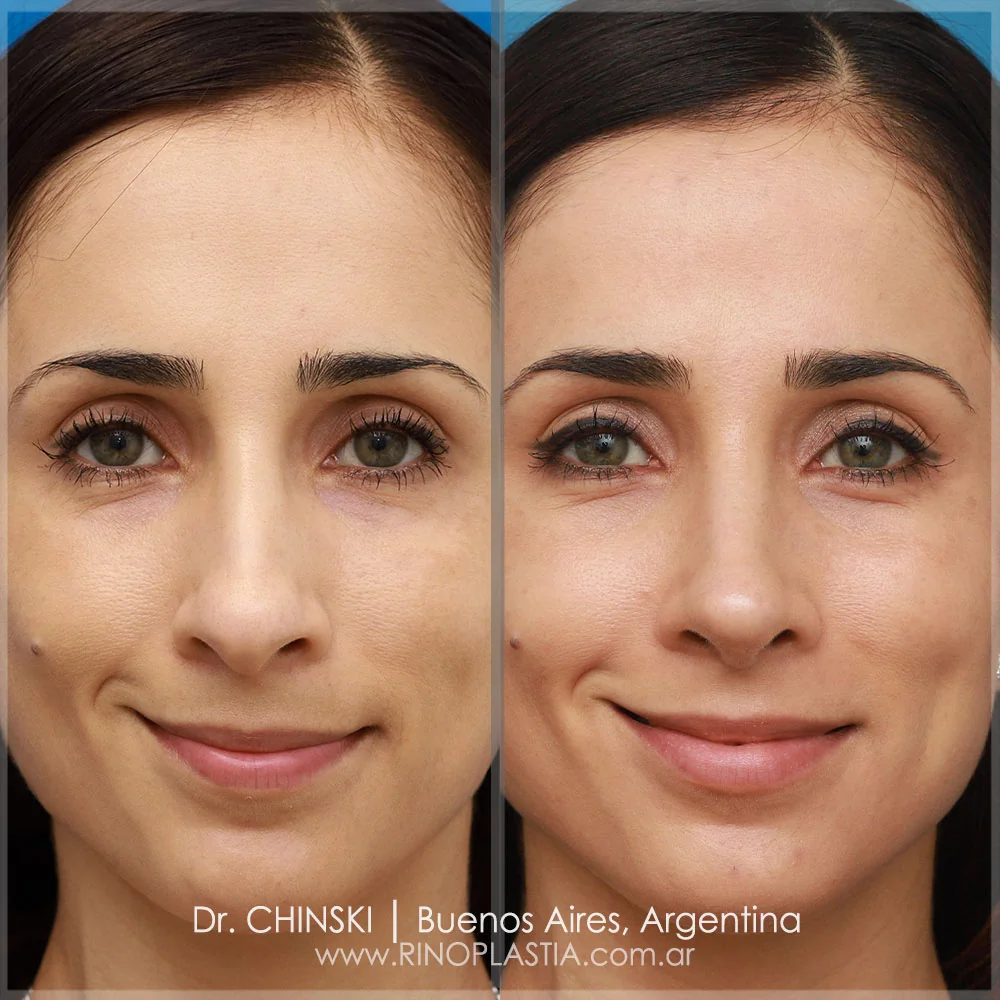 Antes e depois de rinoplastia – caso 128