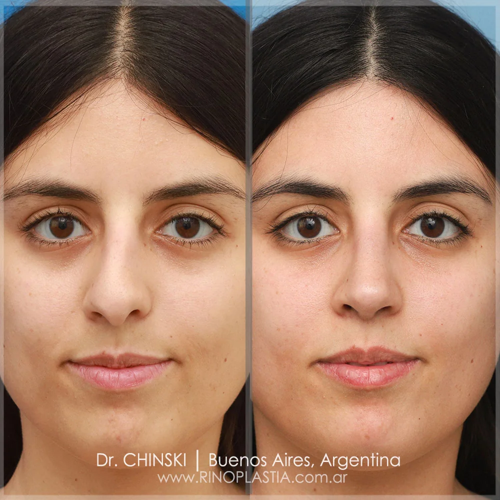 Antes e depois de rinoplastia – caso 129