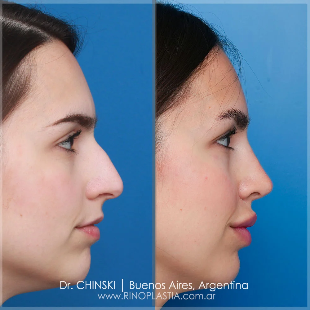 Rhinoplasty before and after – case 13