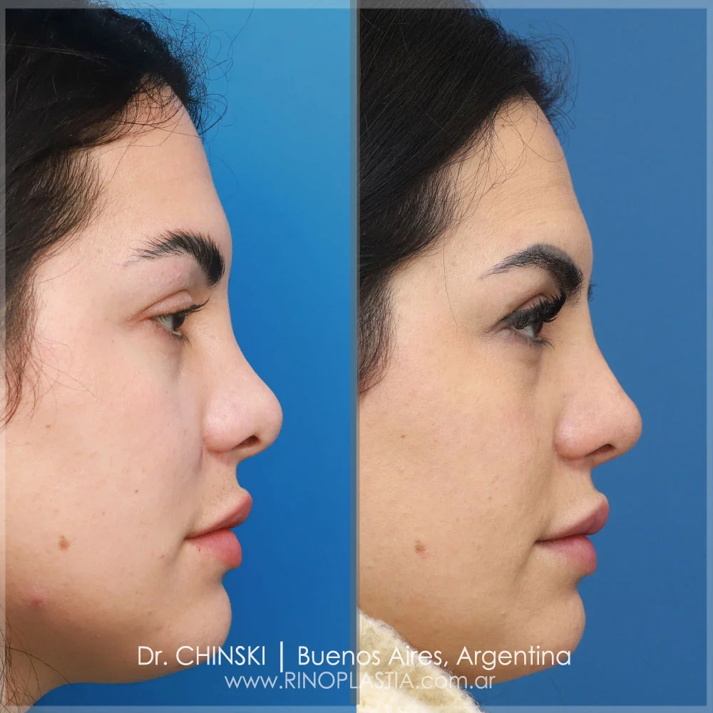 Antes y después de rinoplastia – caso 130