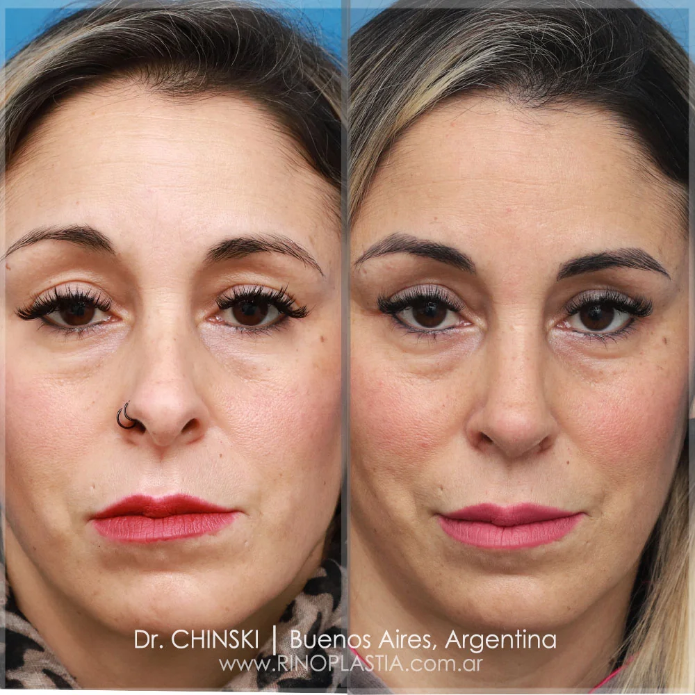 Rhinoplasty before and after – case 131