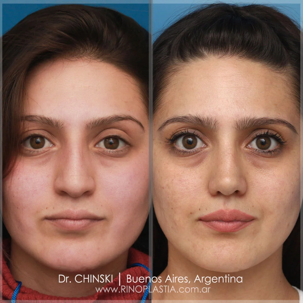 Antes e depois de rinoplastia – caso 132
