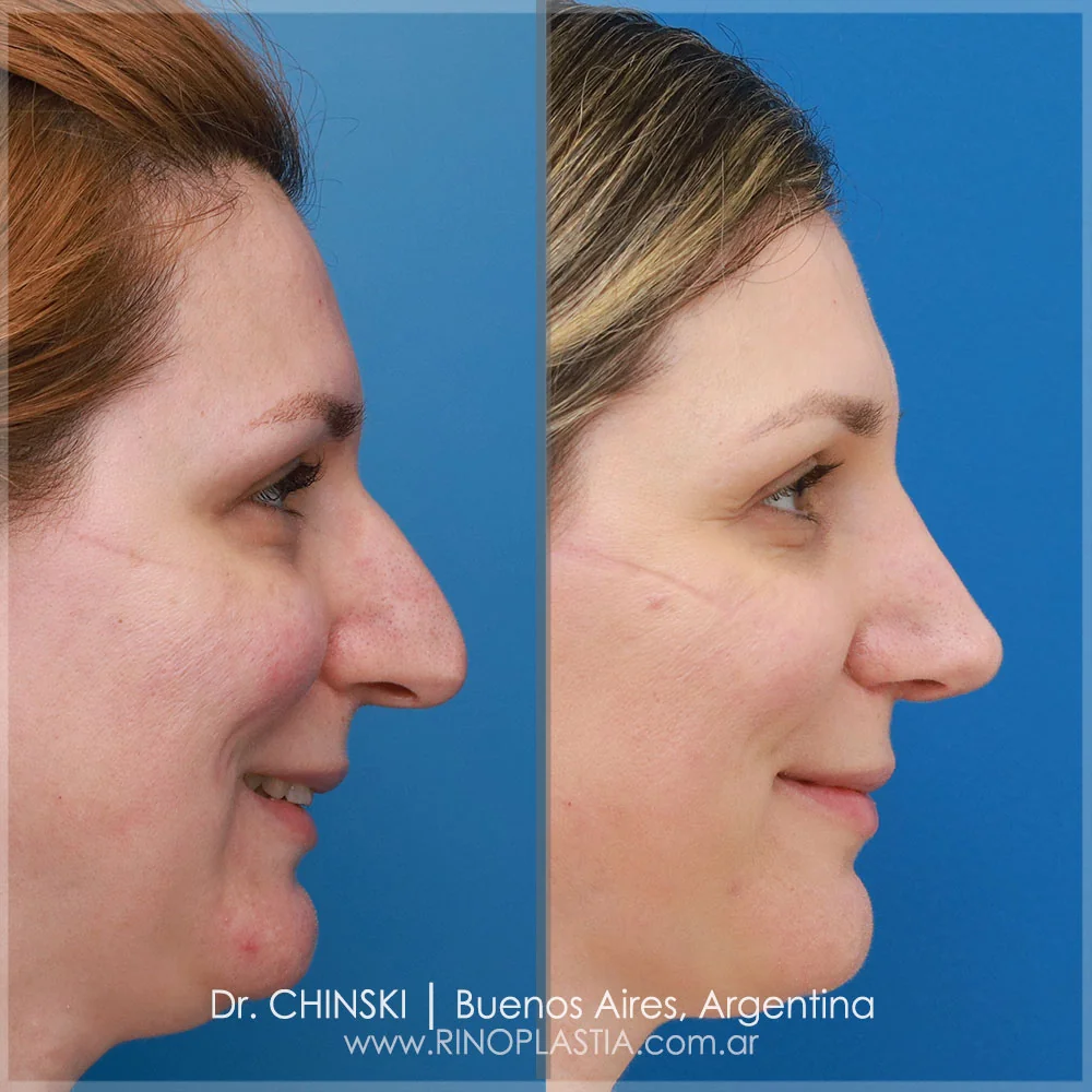 Antes e depois de rinoplastia – caso 133