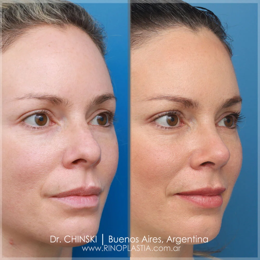 Antes e depois de rinoplastia – caso 134