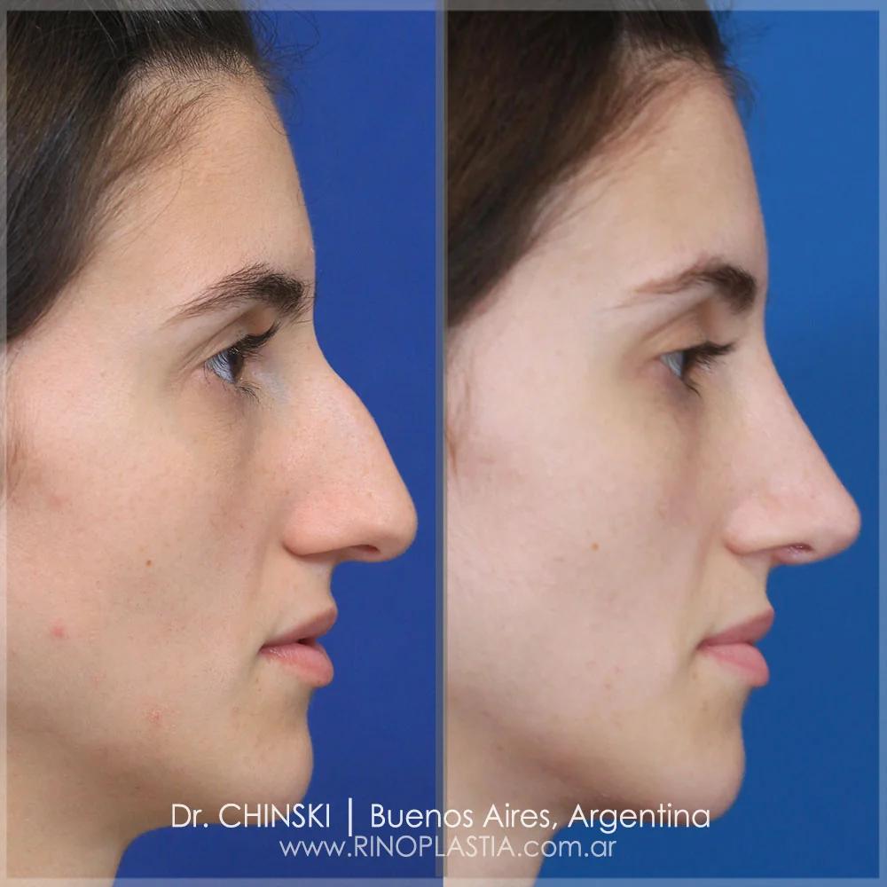 Antes e depois de rinoplastia – caso 135