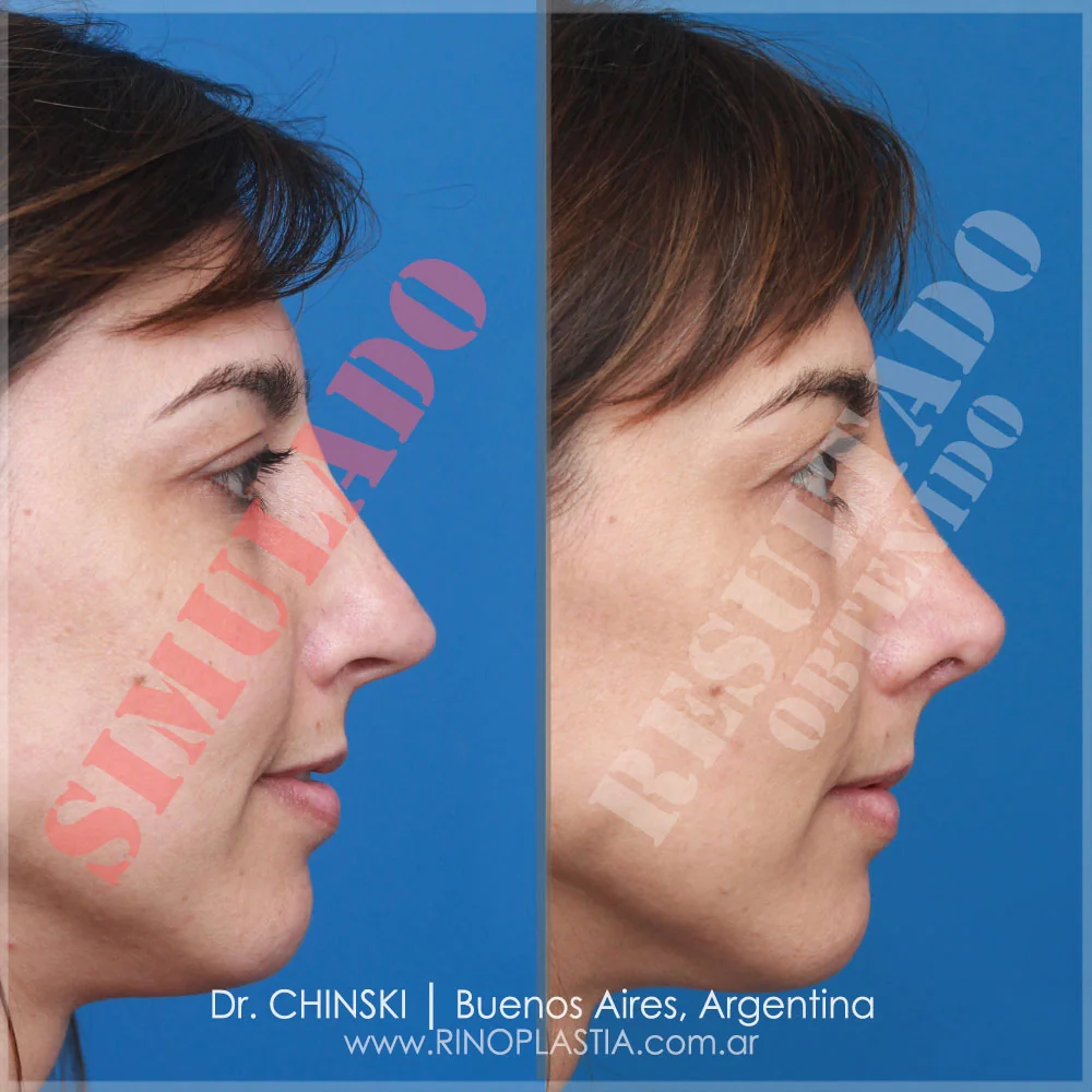 Antes y después de rinoplastia – caso 136