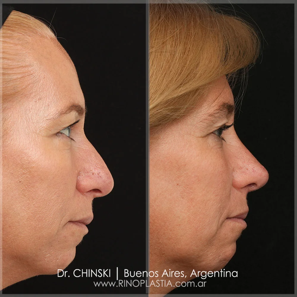 Antes e depois de rinoplastia – caso 137