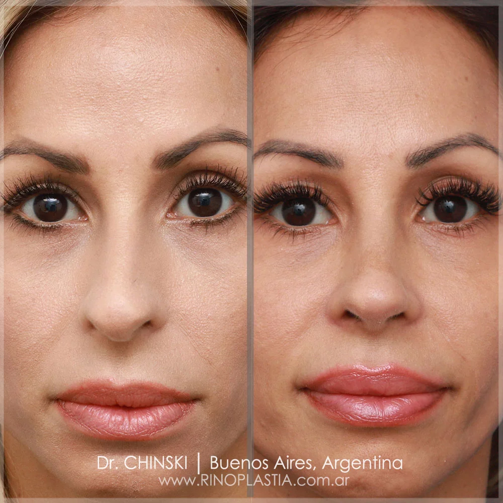 Antes e depois de rinoplastia – caso 138