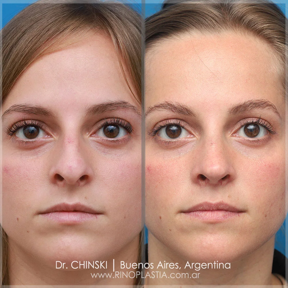 Antes e depois de rinoplastia – caso 139