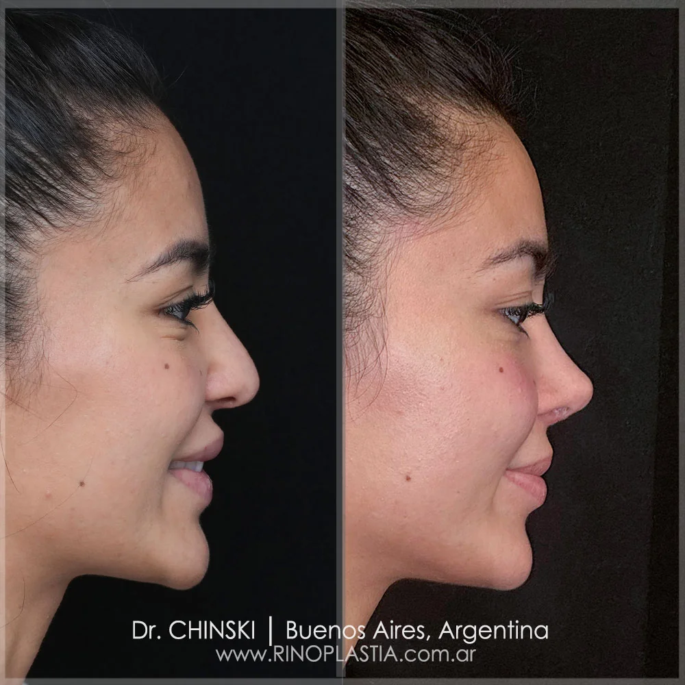 Rhinoplasty before and after – case 14