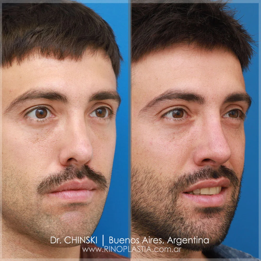 Rhinoplasty before and after – case 140
