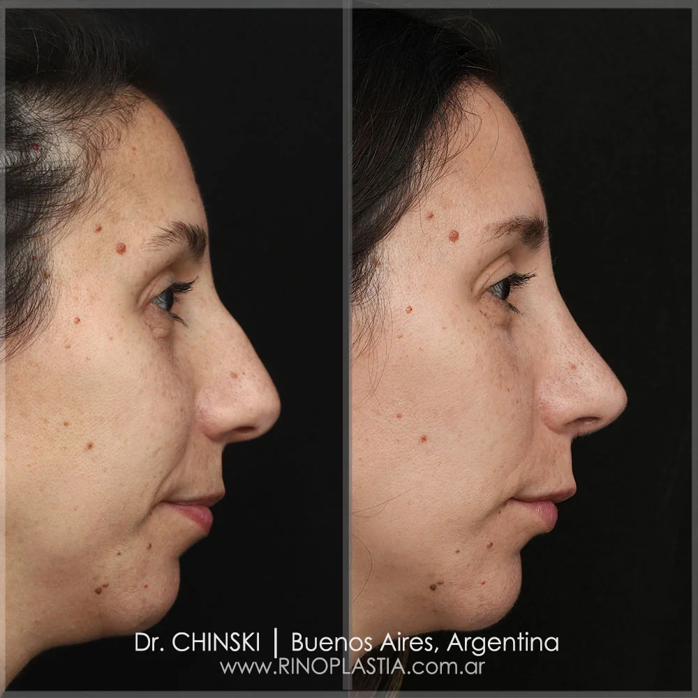 Antes e depois de rinoplastia – caso 141